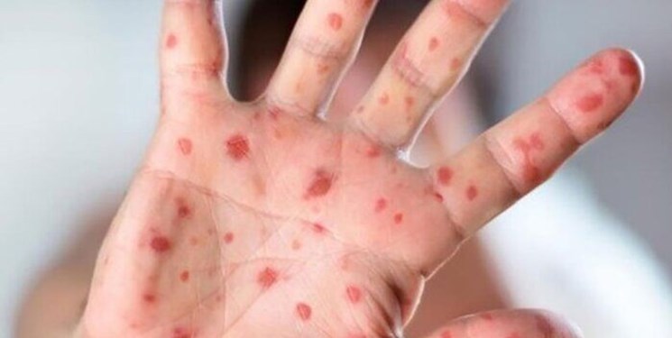 آخرین وضعیت سرخک در مازندران/ سرانجام ۵۹ بیمار مشکوک چه شد؟